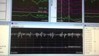 Intraoperative Neuromonitoring