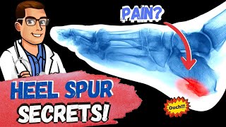 BEST Heel Spur Treatment [Heel Spur Removal, Stretches & Massage!]