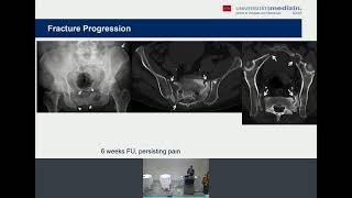 3. Orthogeriatrie Tag 2021 -  Session II - Fragility Fractures of the Pelvis - Wagner