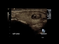 thyroid gland with multiple nodules