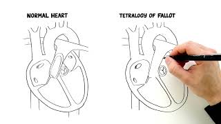 Congenital Heart Defects Explained: Tetralogy of Fallot