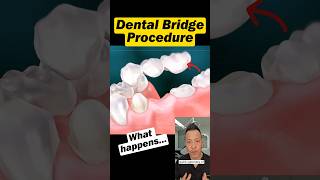 Missing a Tooth? Here’s How a Dental Bridge Is Done #dentallan #dentist #shorts