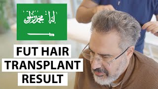 Saudi Arabia Patient FUT Hair Transplant Result - Dr. Ali Emre Karadeniz