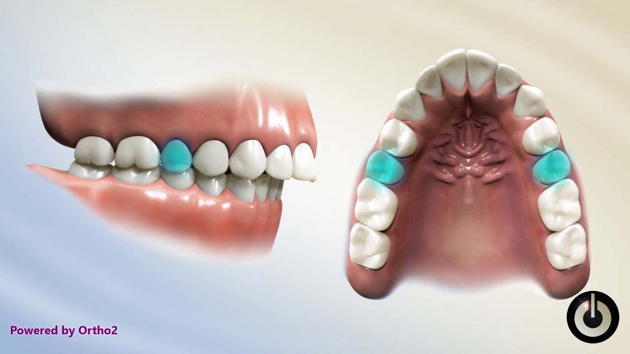 Upper Second Premolar Extraction | Dental Braces | Temecula Valley, CA ...