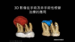 3D 影像在手術及非手術性根管治療的應用