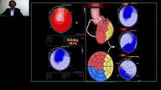 Vivid Talks - ECHO beyond EF – Diagnosis to Prognosis with Dr. R.Manivasagam