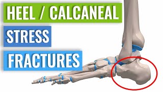 Heel/Calcaneal Stress Fracture: Causes, Symptoms & Treatment