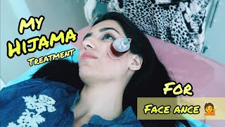 Hijama Treatment for Face Acne | Nida Gul Khan | My First Hijama Cupping..