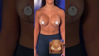 Review Revision Breast Surgery With Dr. Farber - 2 Weeks Post-Op
