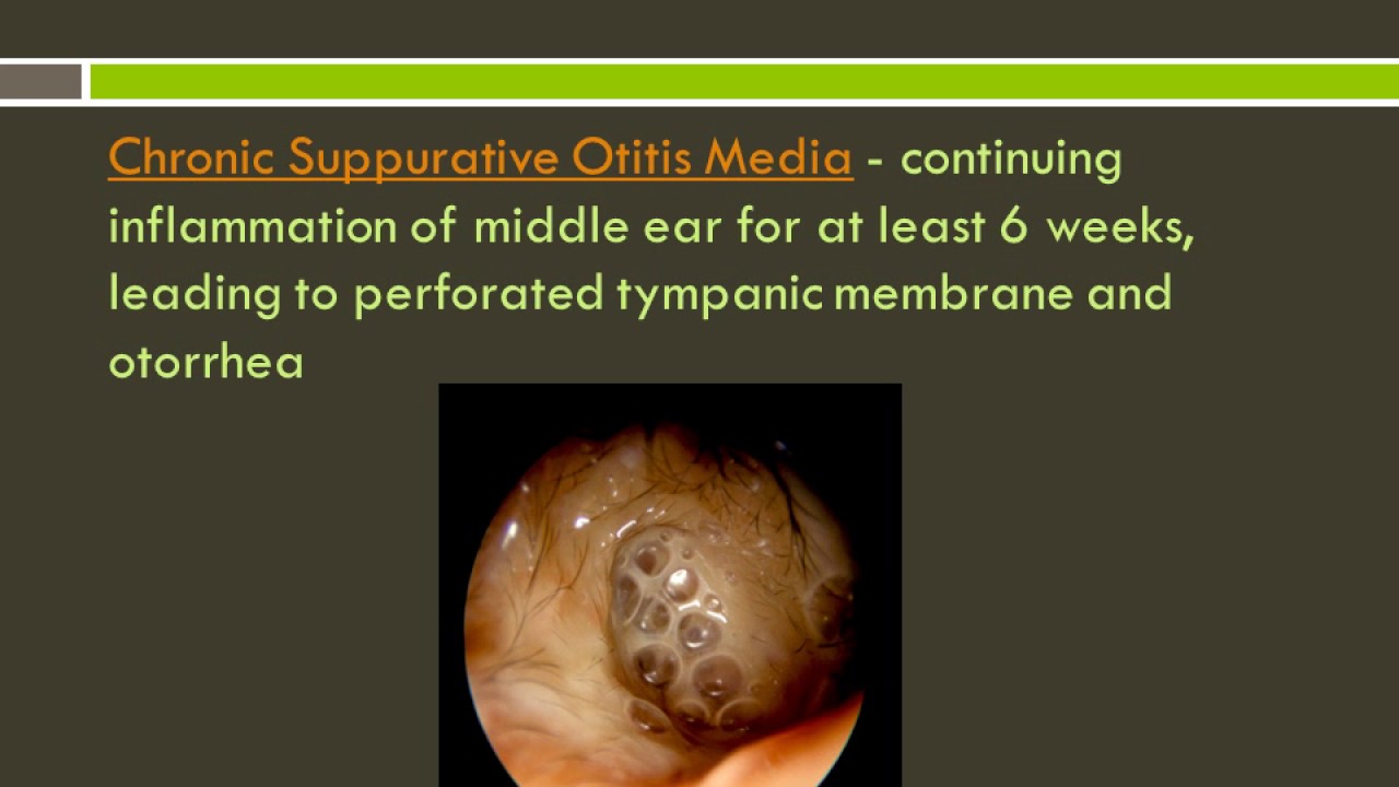 Otitis Media Supurativa