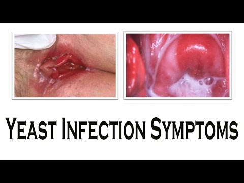 Severe Vaginal Yeast Infection - What Are Its Symptoms Severe Vaginal Yeast Infection - What Are Its Symptoms