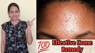 how to get rid of tiny bumps on face 🤦🏻‍♂|| Small pimples on forehead in ಕನ್ನಡ❤