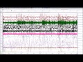 Scoring A Sleep Study:  Uncut, Patient with RERAs, UARS