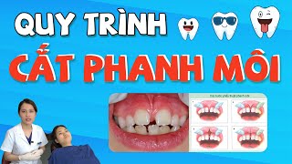 Cận Cảnh Quy Trình Cắt Phanh Môi Điều Trị Khe Thưa Răng Cửa Chỉ Trong Nháy Mắt