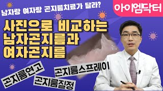 남자곤지름과 여자곤지름 차이