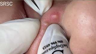 Big Cystic Acne Blackheads Extraction whiteheads removal pimple popping