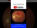 Retinal Venous Occlusion Fundoscopy