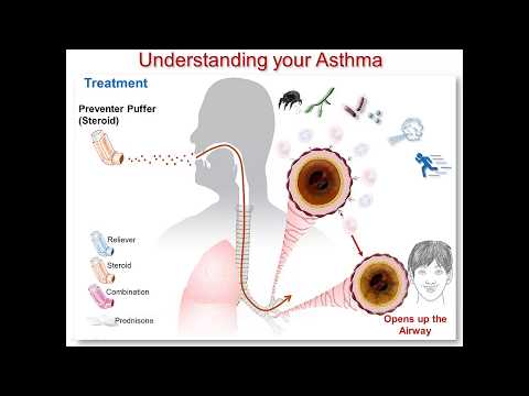 Understanding Your Asthma Part 3: Steroid Medication Understanding Your Asthma Part 3: Steroid Medication