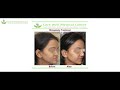 what tests should be done before rhinoplasty part 2 care well medical centre