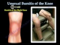 Unusual Bursitis Of The Knee - Everything You Need To Know - Dr. Nabil Ebraheim