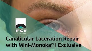 Canalicular Laceration Repair with Mini-Monoka® | Exclusive