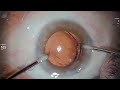 dr stanimir troshev cataract surgery livestream acunex vario