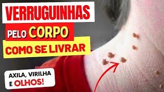 O Que São e COMO SE LIVRAR de VERRUGUINHAS no Pescoço, Rosto, Virilha e Axilas