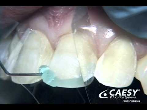 Tooth bonding Tooth bonding