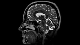 3D T2 brain MRI imaging