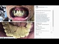 It's REAL!  Blackhead King's Most Bizarre Teeth!