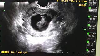 Increased nuchal translucency 11 weeks