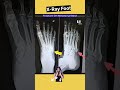 Fracture 5th Metatarsal | X-ray Foot #shorts #xray