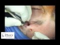 Watch Common Procedures Combined with Upper Blepahroplasty