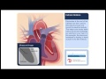 Catheter Ablation Animation Video