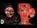 Mujer lucha contra mortal tumor en su ojo | Mi cuerpo, mi desafío | Discovery Latinoamérica