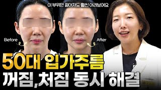 입가주름, 입가처짐, 마리오넷주름 없애는 법. 진짜 좋아집니다. 50대이상 필수시청!