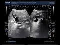 Ultrasound Video showing a bunch of multiple polyps in Gall Bladder.