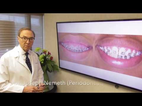 Your Braces Could Be Causing Gum Problems Your Braces Could Be Causing Gum Problems