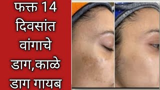 वांग उपाय | pigmentation | ना क्रीम ना पार्लर घरगुती पद्धतीने घालवा वांग आणि काळवटपणा | kitchen tips