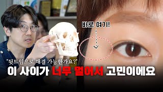 뒷트임하면 당연히 이 사이가 좁아지는 거 아니에요?! 너무 많이 하는 착각