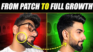 This is How I Treated a DANGEROUS Beard Patch? 😰 Alopecia Areata Treatment | The