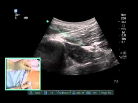How To Ultrasound Guided Subgluteal Sciatic Nerve Block Scanning