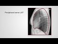 Radiological zones—and an introduction to landmarks