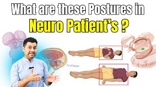Understand Decorticate & Decerebrate Postures in 2 Minutes.