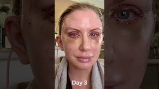 10 YEARS YOUNGER IN 3 WEEKS! Facelift Patient's Amazing Transformation