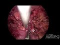 simultaneous bilateral laparoscopic nephrectomy retroperitoneal prone approach in children