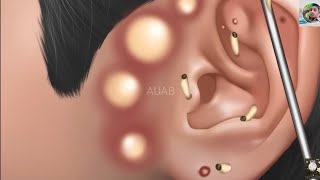 ASMR Pimple blackhead and sebaceous cyst removal for gamer | Massage ear - Tingle animation #asmr