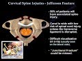 Jefferson Fracture - Everything You Need To Know - Dr. Nabil Ebraheim