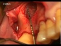 Maxillary Implant Placement and Sinus Lift