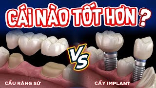 Nên Làm Cầu Răng Sứ Hay Cấy Ghép Implant? Chọn Sai Giải Pháp, Hối Hận Cả Đời!